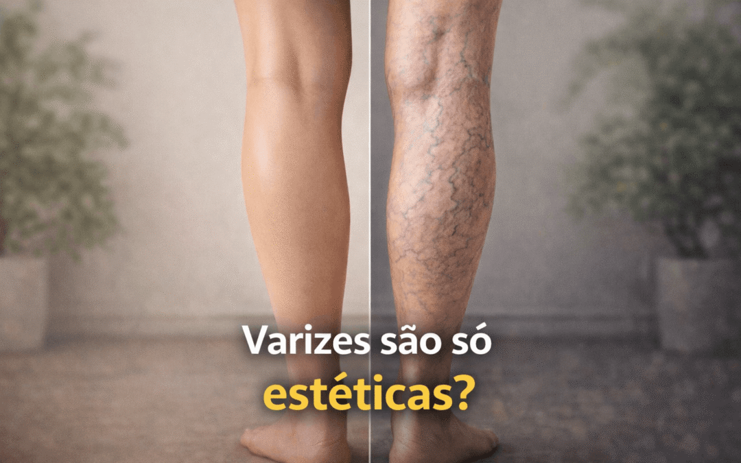 Blog O que são varizes nas pernas (1)