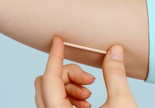 Inserção de implante hormonal contraceptivo